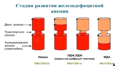 стадии развития железодефицитной анемии