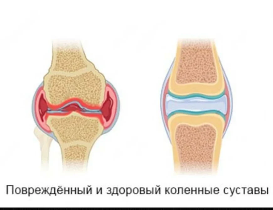 больной и здоровый суставы